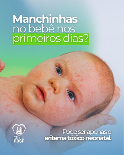 Post da Clínica PBSF: manchinhas no bebê nos primeiros dias